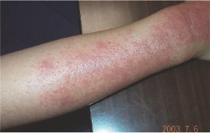 dermatite atopique chez une femme âgée de  25 ans