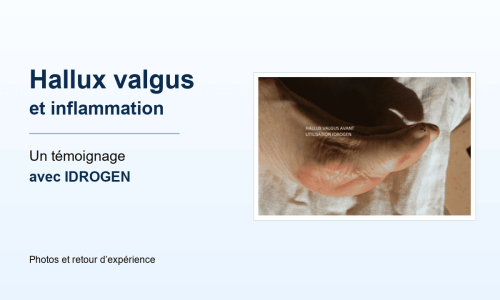 Hallux valgus et inflammation : un témoignage avec IDROGEN