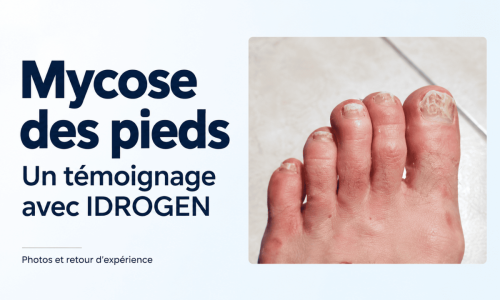 Eau hydrogénée et mycose des pieds : un témoignage avec IDROGEN