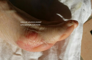 Hallux valgus, oignon pied, inflammation traitement naturel par IDROGEN